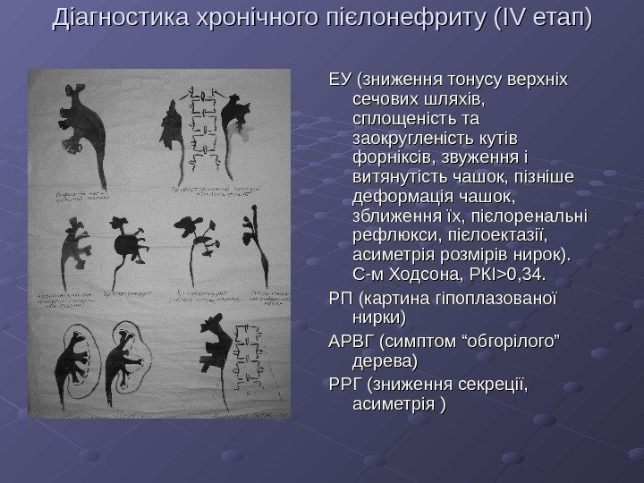   Діагностика хронічного пієлонефриту ( IVIV етап) ЕУ (зниження тонусу верхніх сечових шляхів,